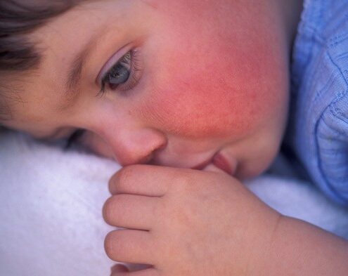 אסתמת עור / אטופיק דרמטיטיס